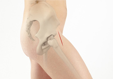 Anterior Hip Replacement