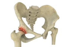 Comprehensive Care of Hip Osteoarthritis