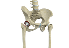 Correction of a Failed Hip Replacement