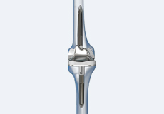 Correction of a Failed Knee Replacement