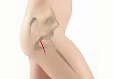 Mini-Posterior Hip Replacement