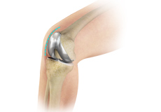 Outpatient Total Knee Replacement