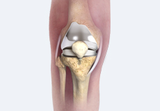 Patient Specific Knee Replacement