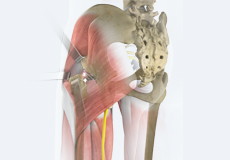 Posterior Hip Replacement