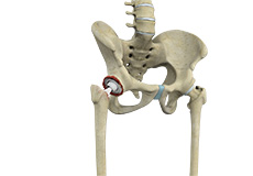 Revision Hip Replacement