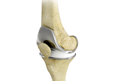 Total Knee Replacement