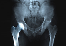 Transient Osteoporosis of the Hip